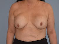 Breast Lift Before & After Gallery - Patient 17338199 - Image 1