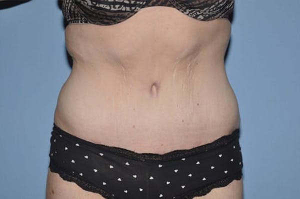 After Weight Loss Surgery Before & After Gallery - Patient 6389622 - Image 2