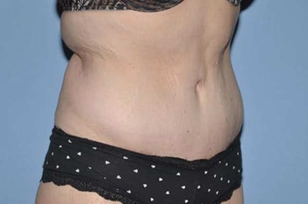 After Weight Loss Surgery Before & After Gallery - Patient 6389622 - Image 4