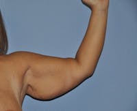 Arm Lift Before & After Gallery - Patient 6389551 - Image 1
