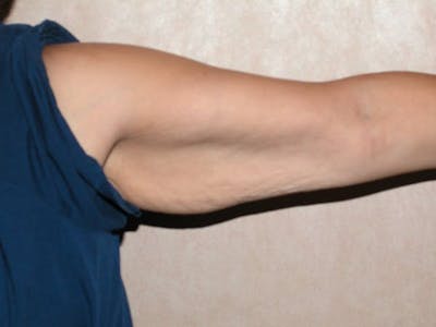 Arm Lift Before & After Gallery - Patient 6389553 - Image 1