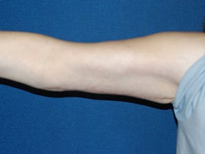 Arm Lift Before & After Gallery - Patient 6389553 - Image 4