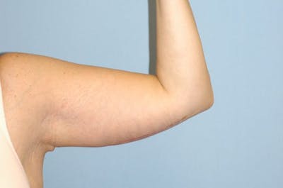 Arm Lift Before & After Gallery - Patient 6389559 - Image 4