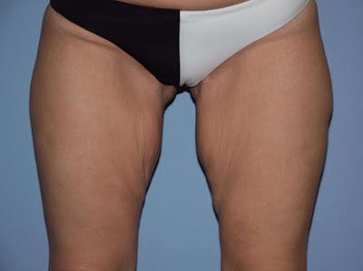 Thigh Lift Before & After Gallery - Patient 6389544 - Image 1