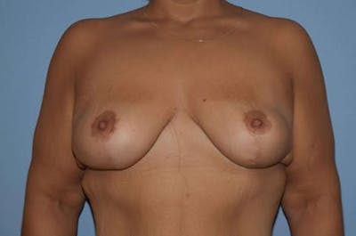 Breast Lift Before & After Gallery - Patient 6389715 - Image 2