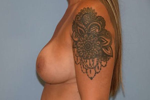 Breast Revision Before & After Gallery - Patient 6389735 - Image 5