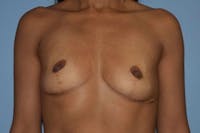 Breast Revision Before & After Gallery - Patient 6389738 - Image 1