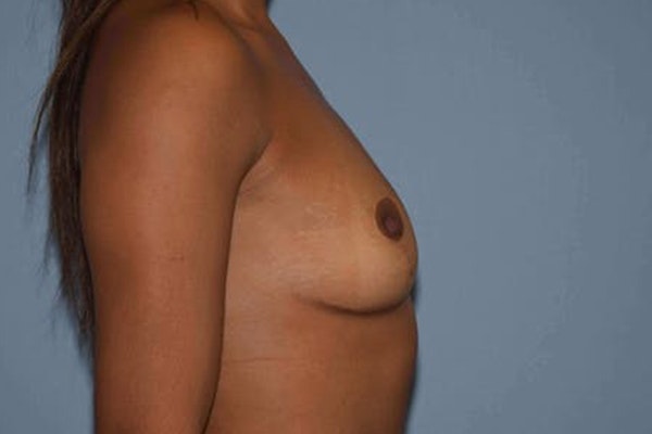 Breast Revision Before & After Gallery - Patient 6389738 - Image 5