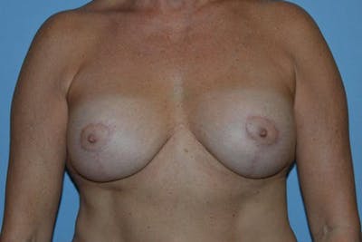 Breast Implant Removal Gallery - Patient 6389693 - Image 1