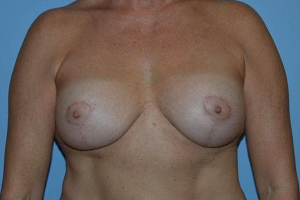 Breast Implant Removal Before & After Gallery - Patient 6389693 - Image 1