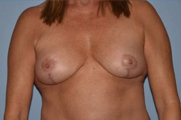 Breast Implant Removal Gallery - Patient 6389693 - Image 2