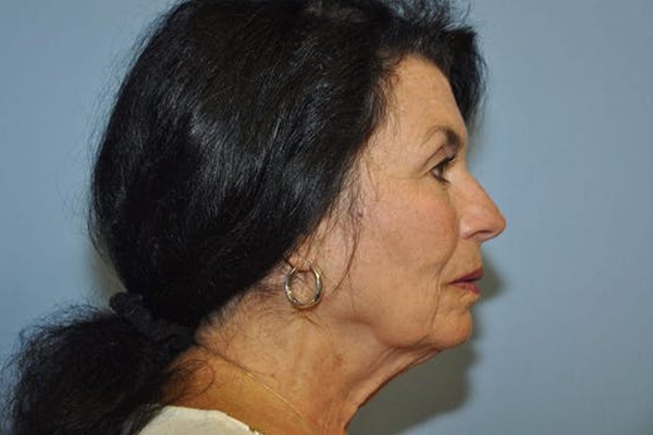 Laser Skin Resurfacing Before & After Gallery - Patient 6389418 - Image 3