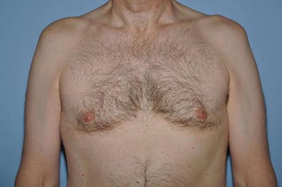 Gynecomastia Before & After Gallery - Patient 6389432 - Image 2