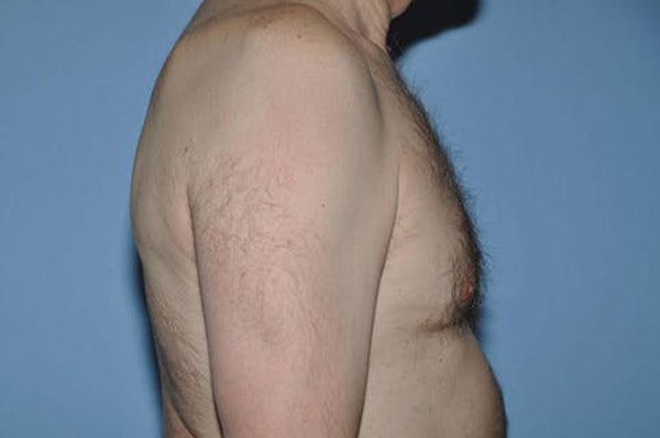 Gynecomastia Before & After Gallery - Patient 6389432 - Image 4