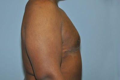 Gynecomastia Before & After Gallery - Patient 6389434 - Image 6