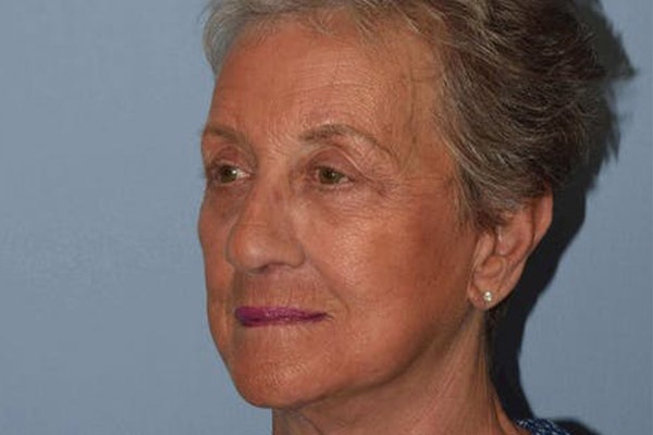 Facelift Before & After Gallery - Patient 6389897 - Image 4