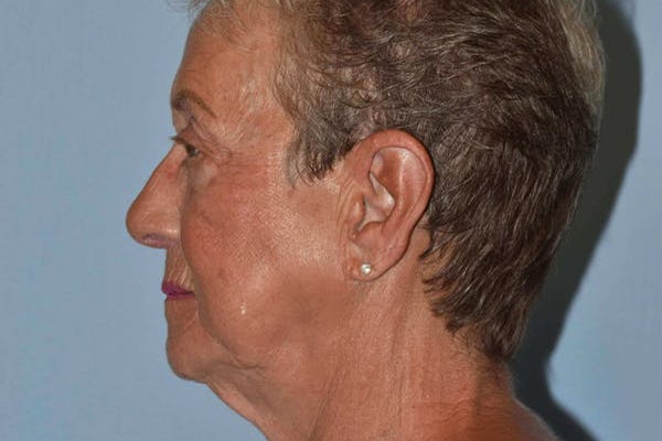 Facelift Before & After Gallery - Patient 6389897 - Image 5