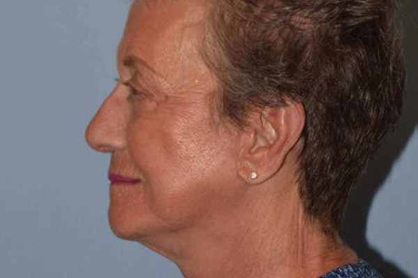 Facelift Before & After Gallery - Patient 6389897 - Image 6