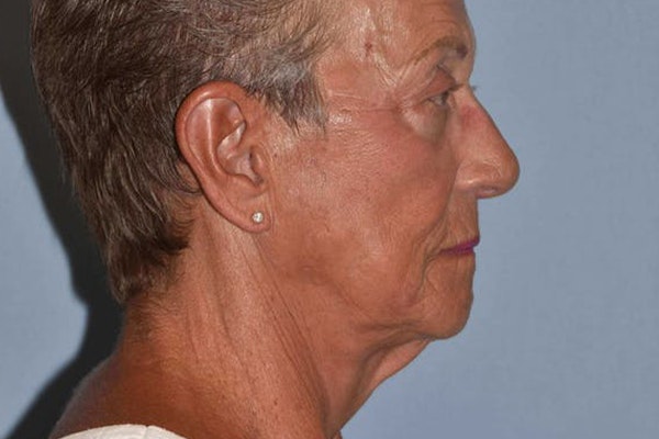 Facelift Before & After Gallery - Patient 6389897 - Image 9