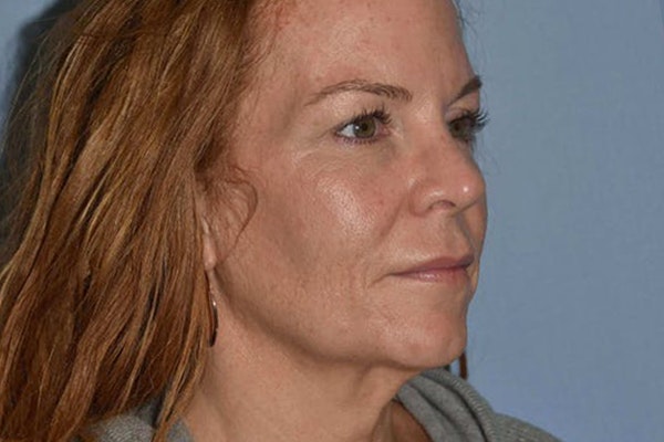 Facelift Before & After Gallery - Patient 6389898 - Image 3