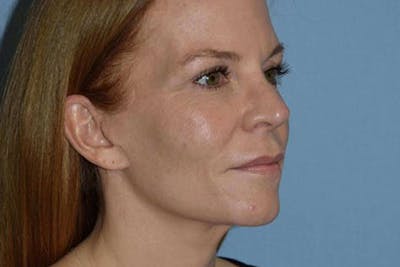 Facelift Before & After Gallery - Patient 6389898 - Image 4