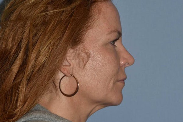 Facelift Before & After Gallery - Patient 6389898 - Image 5
