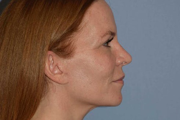 Facelift Before & After Gallery - Patient 6389898 - Image 6