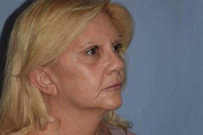 Facelift Before & After Gallery - Patient 6389899 - Image 4