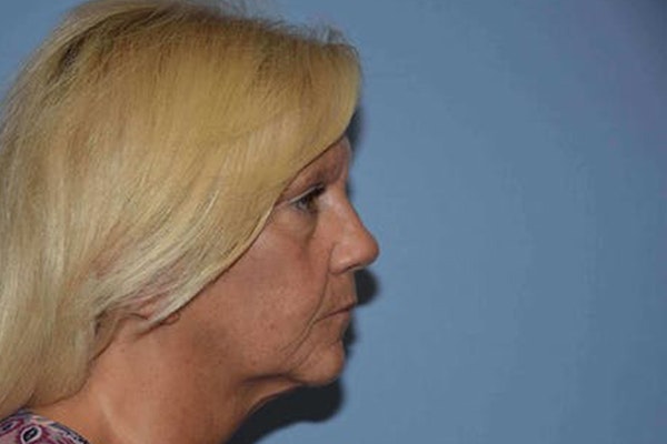 Facelift Before & After Gallery - Patient 6389899 - Image 5
