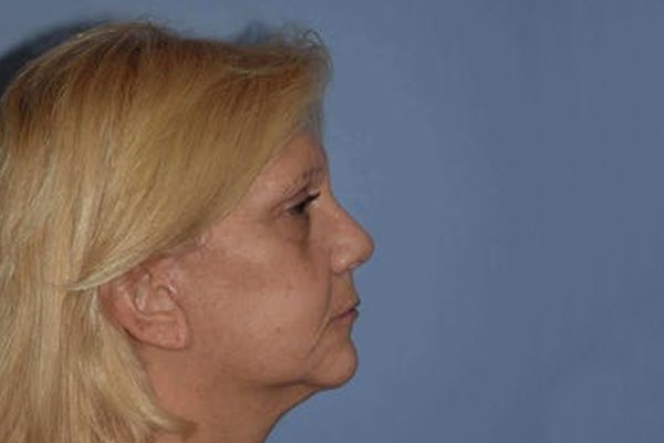 Facelift Before & After Gallery - Patient 6389899 - Image 6