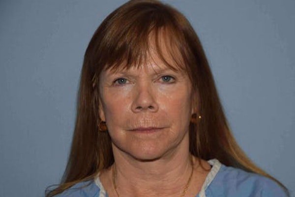 Facelift Before & After Gallery - Patient 6389900 - Image 1