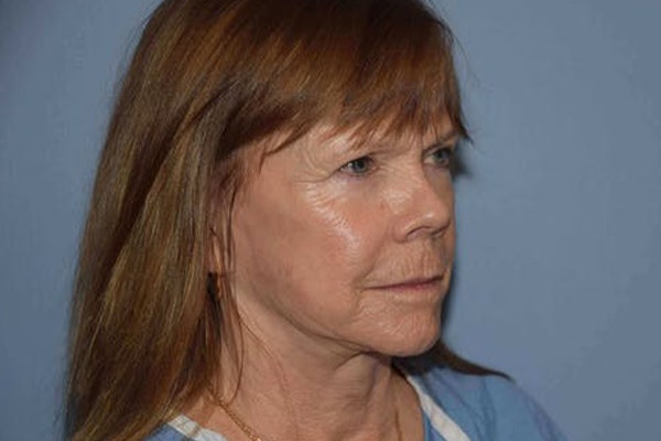 Facelift Before & After Gallery - Patient 6389900 - Image 3