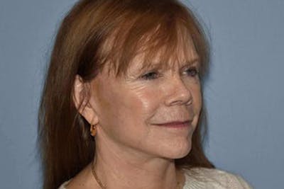 Facelift Before & After Gallery - Patient 6389900 - Image 4