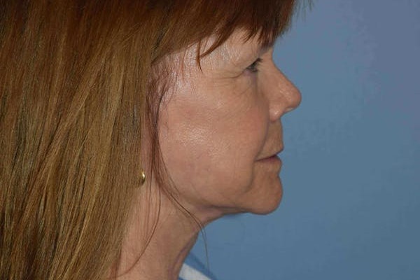 Facelift Before & After Gallery - Patient 6389900 - Image 5
