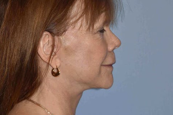 Facelift Before & After Gallery - Patient 6389900 - Image 6