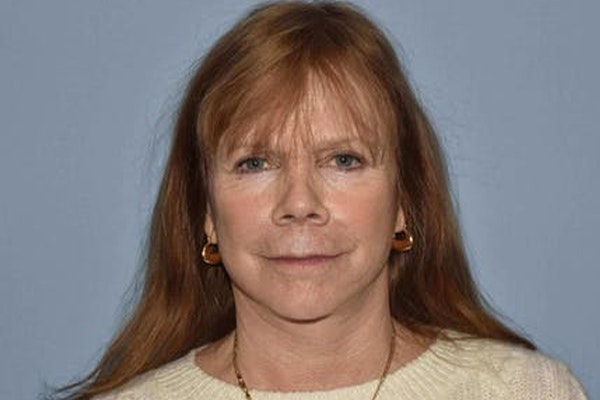 Facelift Before & After Gallery - Patient 6389900 - Image 2