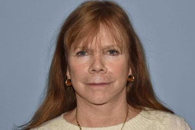 Facelift Before & After Gallery - Patient 6389900 - Image 2