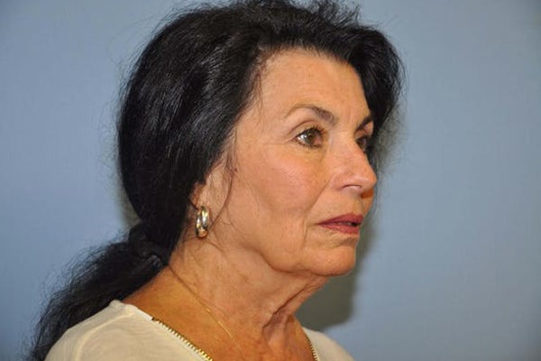 Facelift Before & After Gallery - Patient 6389902 - Image 3