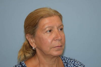 Facelift Before & After Gallery - Patient 6389903 - Image 4