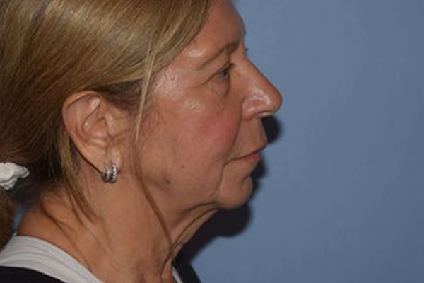 Facelift Before & After Gallery - Patient 6389903 - Image 5