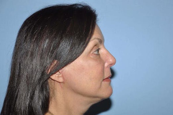 Facelift Before & After Gallery - Patient 6389907 - Image 4