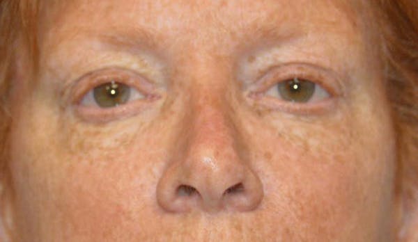 Eyelid Lift Before & After Gallery - Patient 6389469 - Image 1