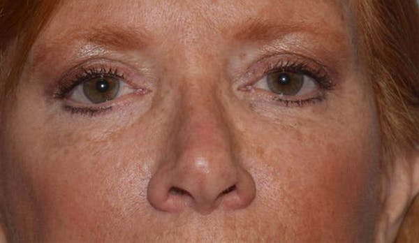 Eyelid Lift Before & After Gallery - Patient 6389469 - Image 2