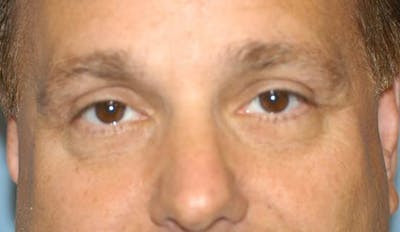 Eyelid Lift Before & After Gallery - Patient 6389474 - Image 2