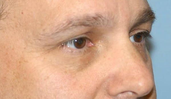 Eyelid Lift Before & After Gallery - Patient 6389474 - Image 3