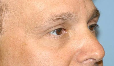 Eyelid Lift Before & After Gallery - Patient 6389474 - Image 4