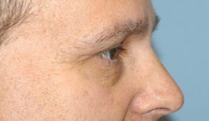 Before and After Blepharoplasty in Long Island