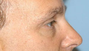 Before and After Blepharoplasty in Long Island