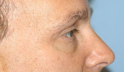Eyelid Lift Before & After Gallery - Patient 6389474 - Image 6