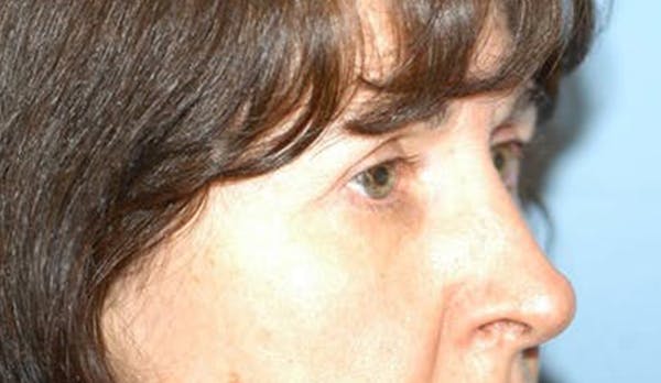 Eyelid Lift Before & After Gallery - Patient 6389476 - Image 4